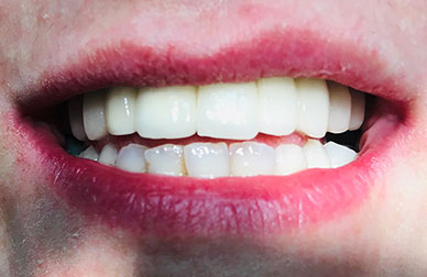 Implantes sobre maxilar muy deteriodado antes