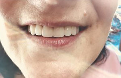 Implantes sobre maxilar muy deteriodado antes