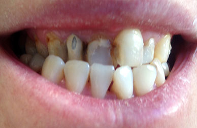 Rehabilitación con coronas antes