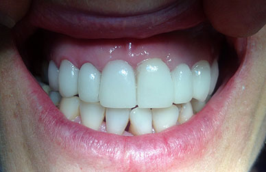 Rehabilitación con coronas después