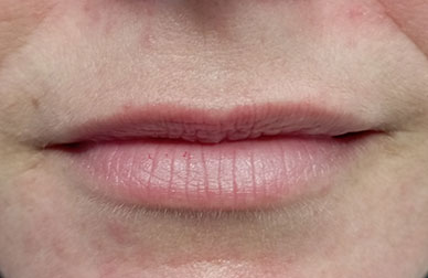 Caso de ácido hilaurónico antes