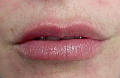 Caso de ácido hilaurónico antes