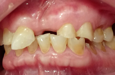 Blanqueamiento antes