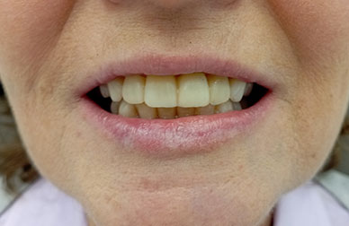 Blanqueamiento después