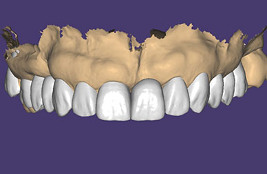 Blanqueamiento durante