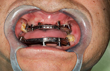 Caso de carga inmediata