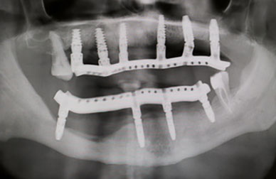 Caso de carga inmediata