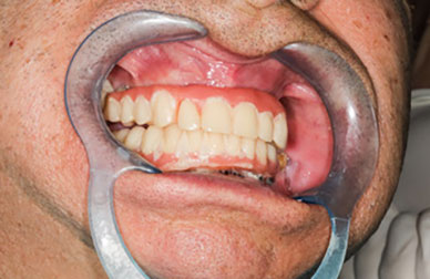 Caso de carga inmediata