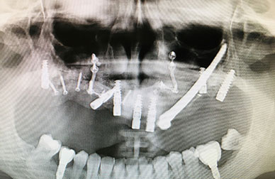 Implantes sobre maxilar muy deteriodado antes