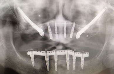 Implantes sobre maxilar muy deteriorado antes
