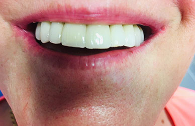 Implantes sobre maxilar muy deteriorado después