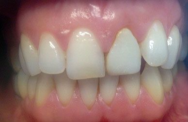 Rehabilitación con carillas antes