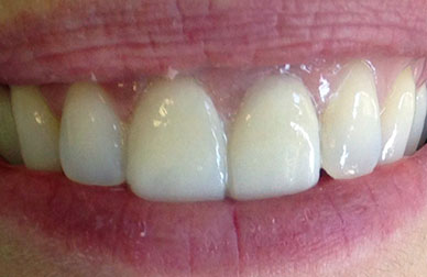 Rehabilitación con carillas después