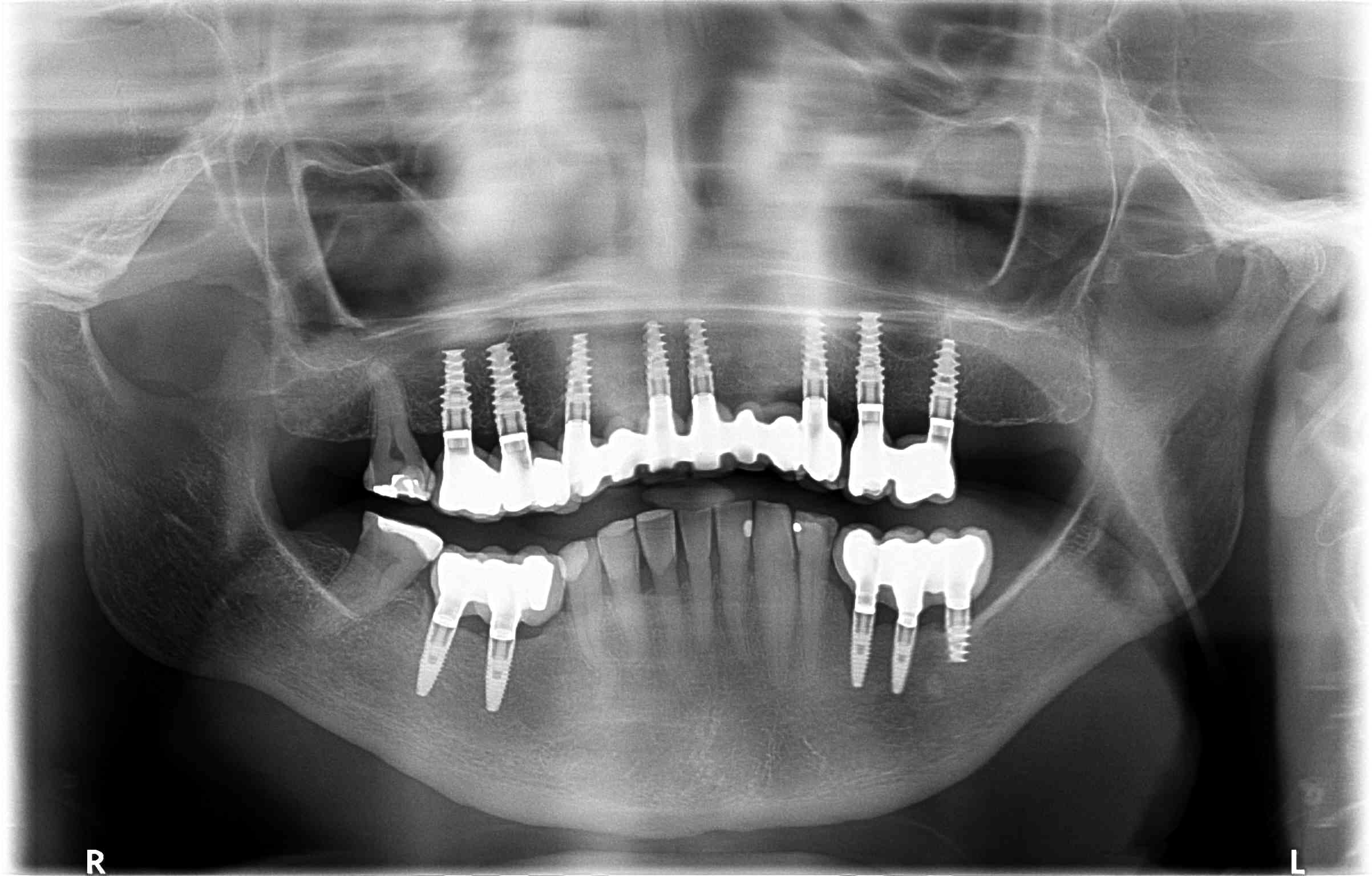 Implantes sobre maxilar muy deteriodado antes
